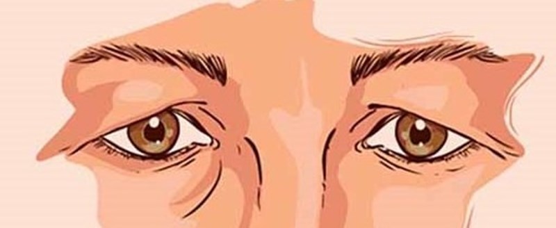 Cách Khắc Phục Mí Mắt Bị Sụp Ở Phụ Nữ Trung Niên