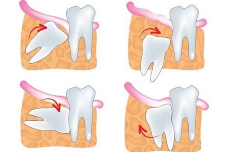 Răng khôn mọc lệch Răng khôn mọc lệch