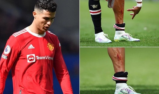 Cristiano Ronaldo bực bội vì Man United thua trận còn bản thân bị phạm lỗi đến chảy máu chân. Ảnh: InsideSport