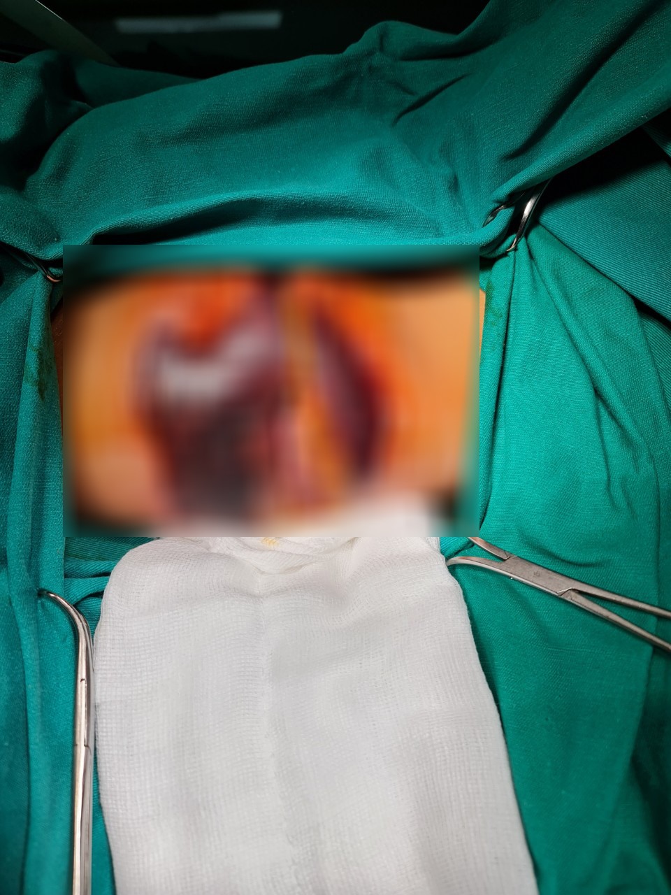 Vết hoại tử do người bệnh tự điều trị bằng thuốc nam. Ảnh: BVCC