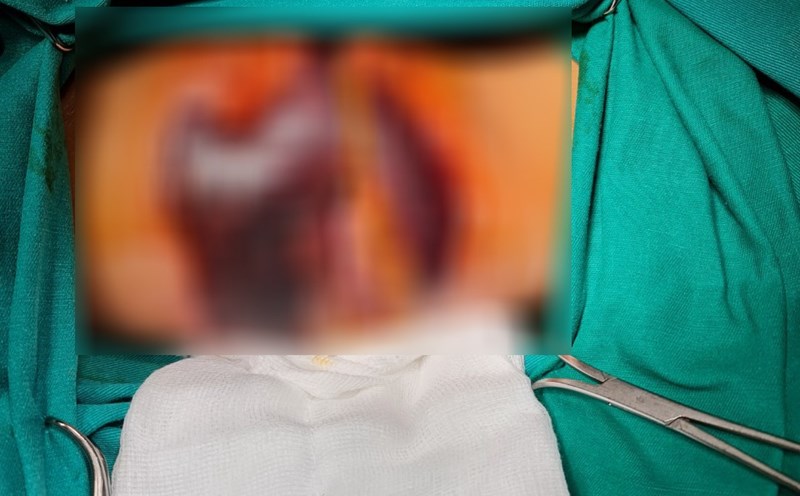 Vết hoại tử do người bệnh tự điều trị bằng thuốc nam. Ảnh: BVCC