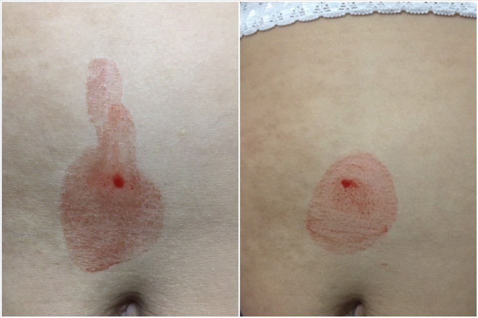 Bệnh nhi 10 tuổi bất ngờ chảy ""mồ hôi máu". Ảnh: BVCC