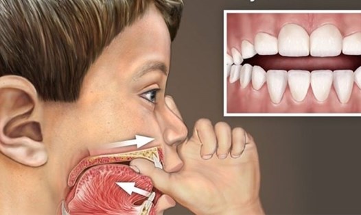 Mút tay, bú bình kéo dài làm ảnh hưởng sức khoẻ răng miệng của trẻ. Ảnh: BV