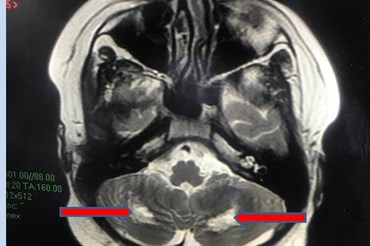 Hình ảnh cộng hưởng từ nhân (MRI) não cho thấy tổn thương chất trắng vùng tiểu não 2 bên gây hiện rối loạn phối hợp vận động, loạng choạng, thất điều. Ảnh: BV