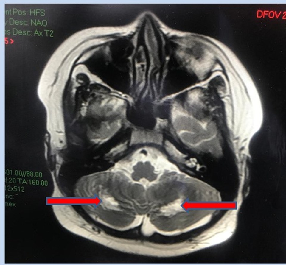 Hình ảnh cộng hưởng từ nhân (MRI) não cho thấy tổn thương chất trắng vùng tiểu não 2 bên gây hiện rối loạn phối hợp vận động, loạng choạng, thất điều. Ảnh: BV Hình ảnh cộng hưởng từ nhân (MRI) não cho thấy tổn thương chất trắng vùng tiểu não 2 bên gây hiện rối loạn phối hợp vận động, loạng choạng, thất điều. Ảnh: BV