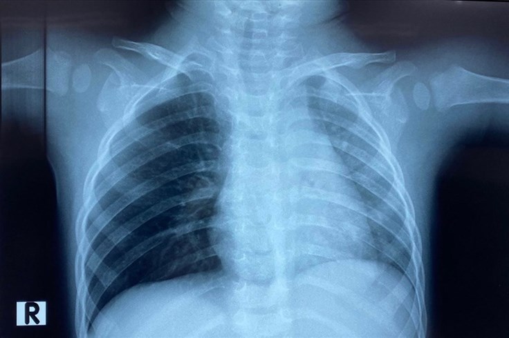 Gắp nhiều mảnh xương lươn sắc nhọn trong đường thở bé trai 1 tuổi
