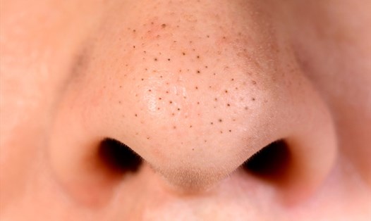 Vùng da mũi thường xuất hiện nhiều mụn đầu đen. Ảnh: Xinhua