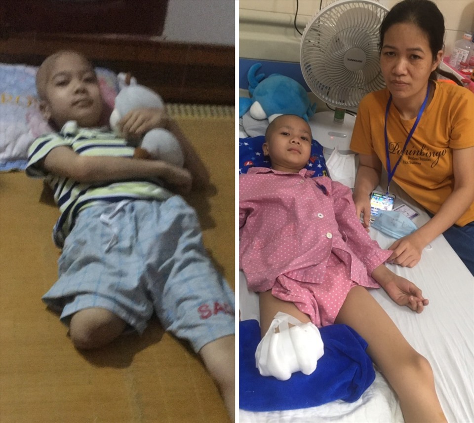 Mắc căn bệnh ung thư xương quái ác, cháu bé 8 tuổi phải cắt bỏ 1 chân. Ảnh: GĐCC