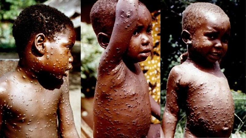 How dangerous is the rare monkeypox that is spreading in Europe and the US?