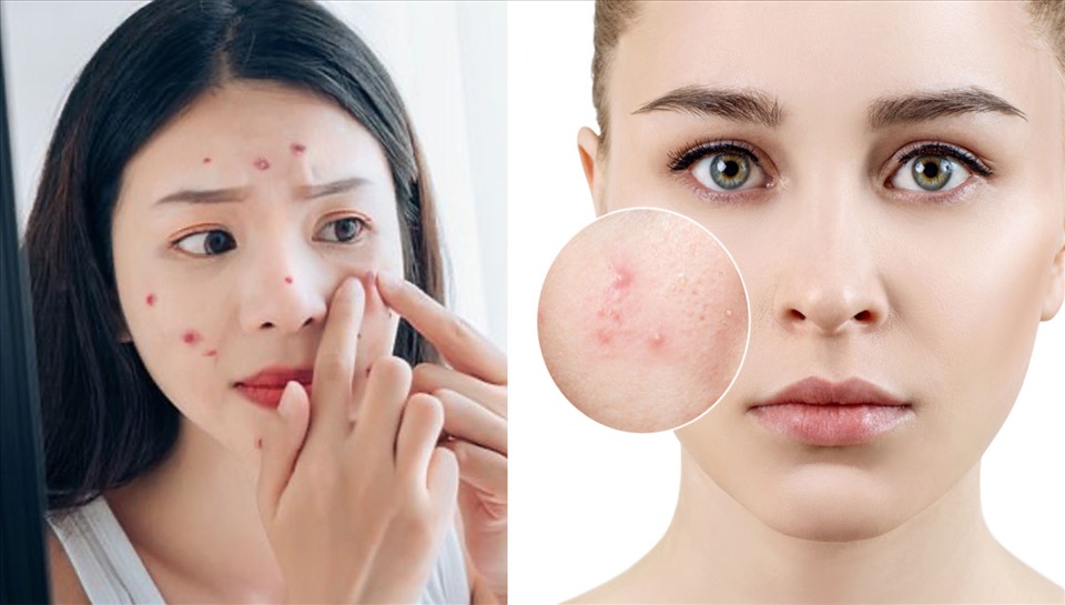 Những nguyên nhân gây ra mụn bọc ở má mà chị em nên lưu ý để phòng tránh.