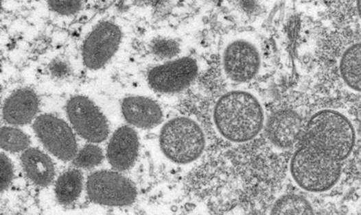 Hình ảnh virus đậu mùa khỉ trên một mẫu da người trong đợt bùng phát ở Hoa Kỳ năm 2003. Ảnh: CDC Hoa Kỳ