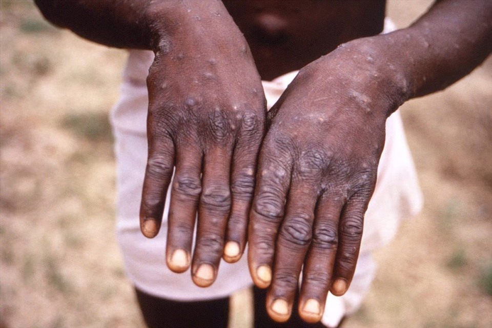 Where in the world has monkeypox spread?