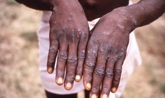 Bệnh đậu mùa khỉ gây ra những tổn thương trên da. Ảnh: AFP