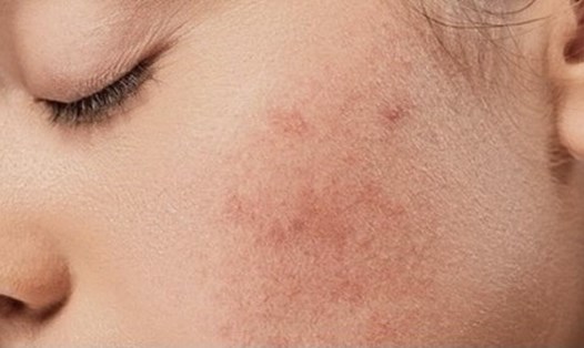 Một trong những nguyên nhân gây da khô và nổi mụn là thức khuya thường xuyên. Ảnh: ST