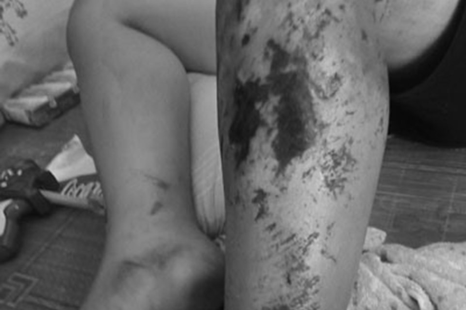 Nhiễm trùng chân khi đắp thuốc nam chữa vết thương bầm tím