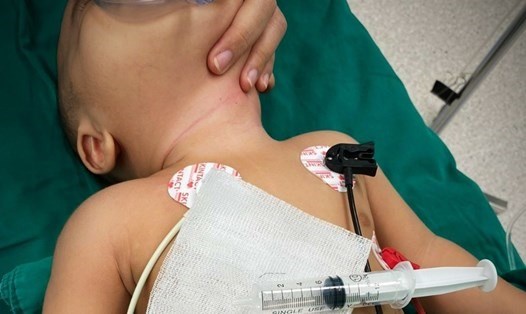 Phẫu thuật lấy dị vật nằm trong đường thở của bé trai hơn 5 tuổi. Ảnh: Chân Phúc