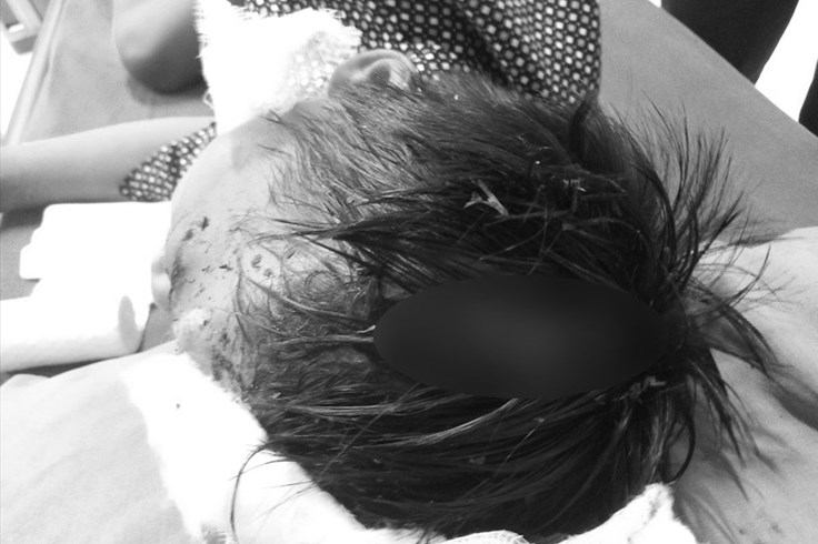 Bé trai 8 tuổi bị chó cắn đa thương tích Bé trai 8 tuổi bị chó cắn đa thương tích