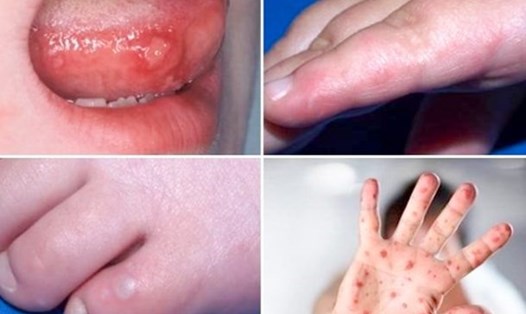 Tay chân miệng là một bệnh truyền nhiễm có thể do nhiều loại virus gây nên. Ảnh: Bệnh viện Nhi Trung ương