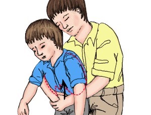Thủ thuật Heimlich đứng khi nạn nhân còn tỉnh.