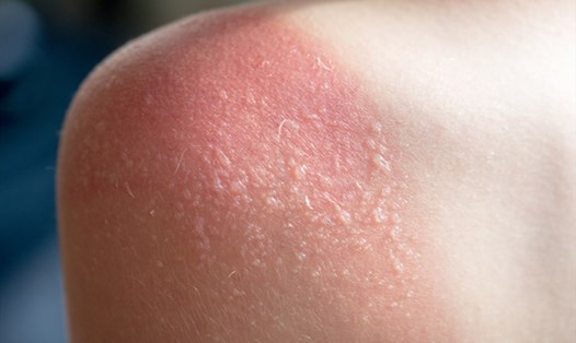 Cháy nắng là nguyên nhân gây ra nhiều tác hại cho làn da cũng như ảnh hưởng đến sức khoẻ con người. Ảnh: Xinhua