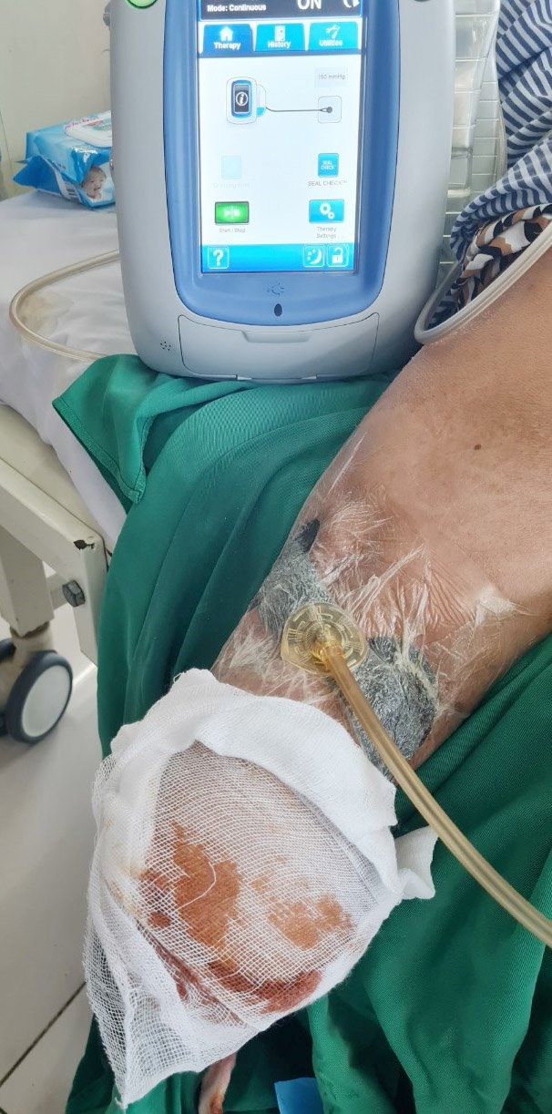 Bệnh nhân Q được theo dõi, chăm sóc sau khi cắt cụt chân. Ảnh: BVCC