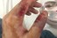 Phẫu thuật bảo tồn ngón tay cho người bệnh bằng vạt da có cuống