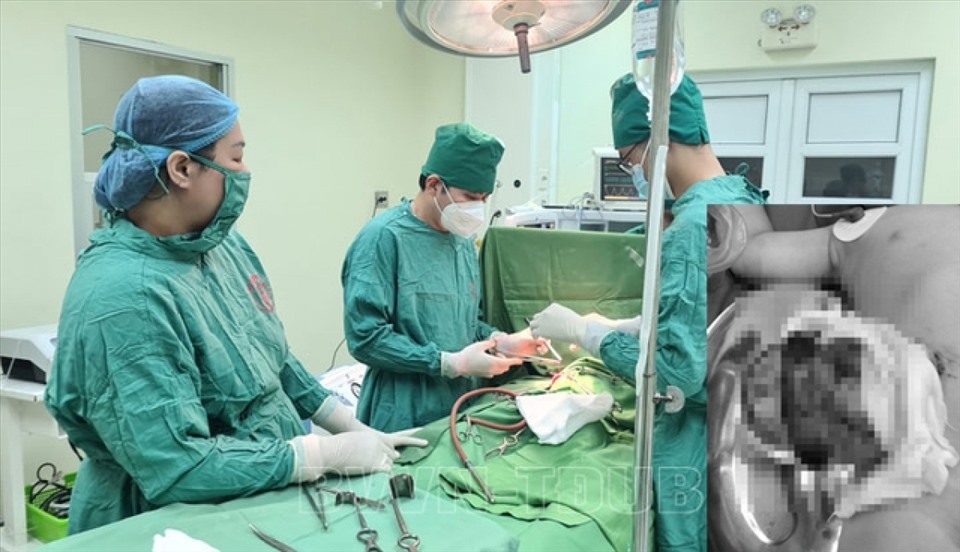Các bác sĩ phẫu thuật cho bệnh nhi 17 tháng tuổi. Ảnh do BV Việt Nam - Thụy ĐIển Uông Bí cung cấp