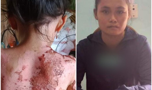 Do ghen tuông, Hà Thị Quyên đã hắt ca nước sôi và 3 mẹ con người hàng xóm khiến bé gái 7 tuổi bị bỏng nặng. Ảnh: MXH.