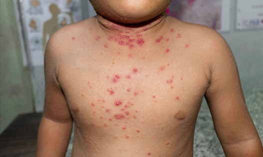Bệnh đậu mùa khỉ thường nặng ở trẻ em, phụ nữ có thai hoặc người suy giảm miễn dịch. Ảnh: Shutterstock