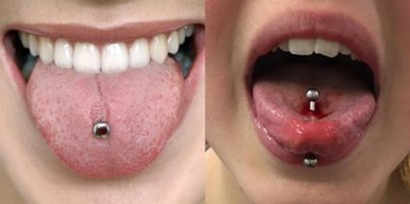 Xỏ khuyên lưỡi có thể gây ảnh hưởng đến răng và nướu