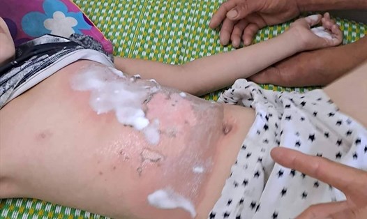 Bé gái Nguyễn Thị CN (10 tuổi) bị điện giật gây bỏng nặng vùng bụng và tay. Ảnh: QĐ