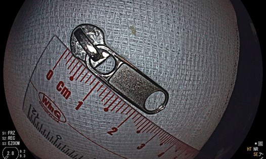 Chiếc khóa sắt dài 2,5cm được gắp ra trong dạ dày em bé 6 tuổi. Ảnh: T.T.