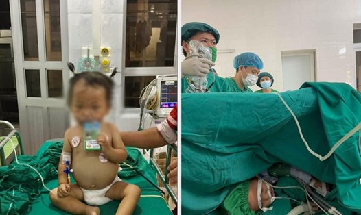 Cháu bé 24 tháng tuổi được phẫu thuật thành công nhờ phương pháp tán sỏi qua da. Ảnh: Phương Lan.