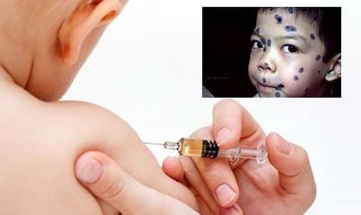 Tiêm vaccine giúp phòng ngừa bệnh thủy đậu hiệu quả, đơn giản. Ảnh: CDC