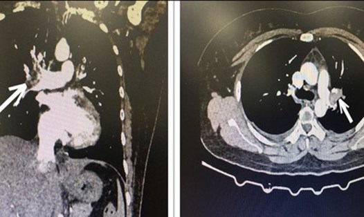 Hình ảnh CT lồng ngực cho thấy bệnh nhân bị tắc động mạch phổi cấp tính. Ảnh: BVCC