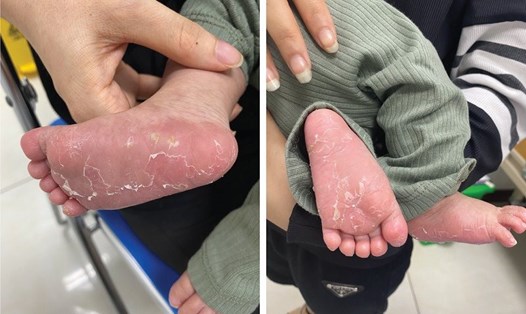 Hình ảnh chóc da chân do trẻ bị mắc bệnh giang mai bẩm sinh. Ảnh: BVCC