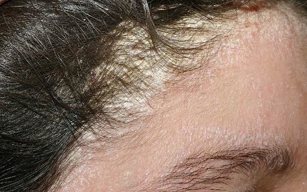 Nấm da đầu và gàu khác nhau như thế nào  Nguyên Xuân