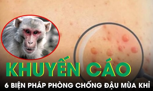 Tỉnh Bạc Liêu tăng cường phòng chống bệnh đậu mùa khỉ. Ảnh: Minh họa