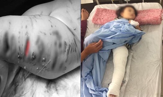 Bé gái 2 tuổi ở Hà Nội bị nhiều vết thương sau khi bị con chó pitbull hung dữ cắn. Ảnh: Việt Long