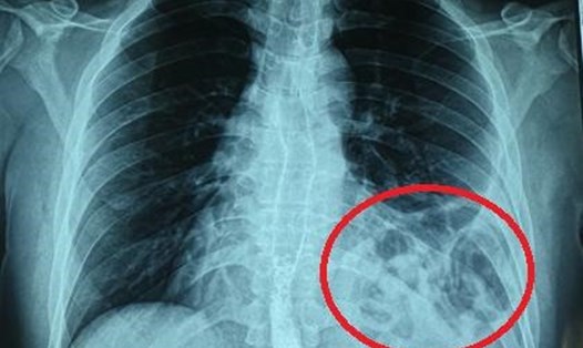 Bóng khí của đại tràng ở trên ngực trái trên X-quang. Ảnh: BVCC