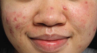 Trị mụn cho da yếu không cần thuốc tại ACNE STUDIO