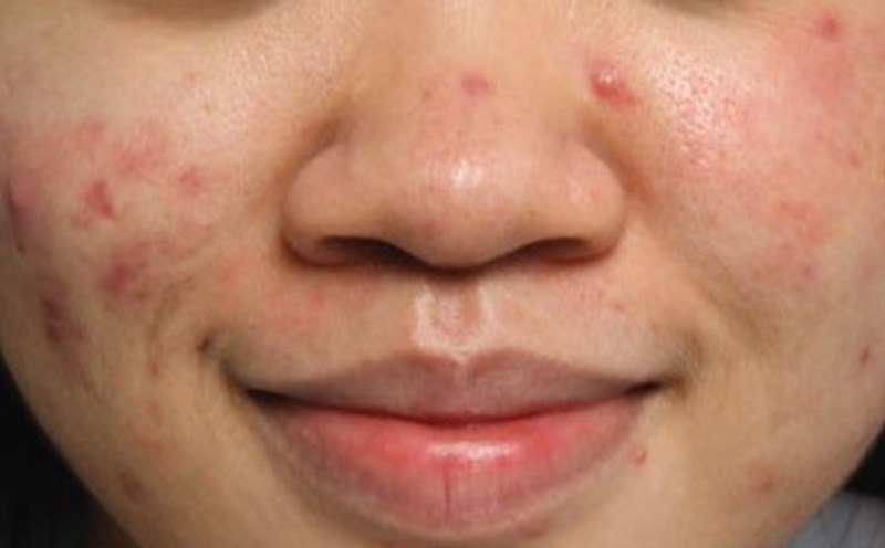 Trị mụn cho da yếu không cần thuốc tại ACNE STUDIO