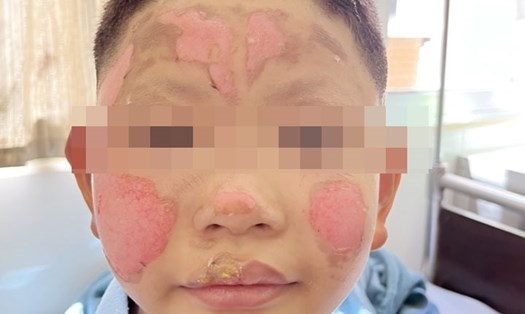 Hình ảnh bệnh nhi với vết bỏng vùng mặt. Ảnh: BVCC