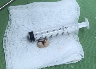 Quảng Ninh: Cấp cứu bệnh nhân với 2 chiếc răng giả trong phế quản