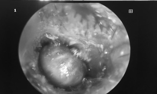 Hình ảnh dị vật là con ve chó trong tai của bệnh nhi. Ảnh:BV Việt Nam -Thụy Điển Uông Bí