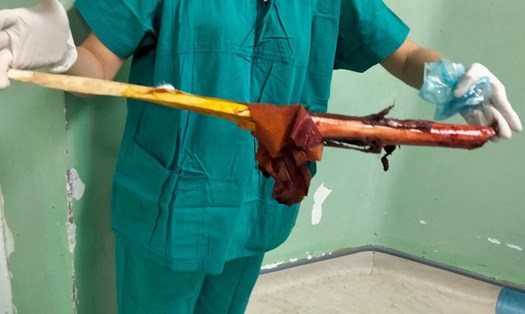Cây gỗ keo đâm xuyên ngực bệnh nhân.
