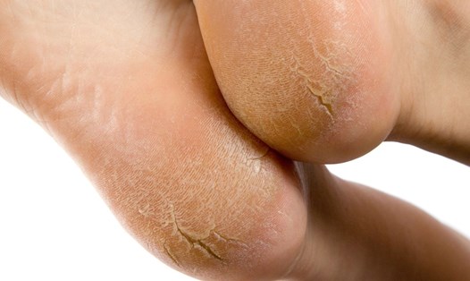 Gót chân bị nứt nẻ là trường hợp dễ gặp khi thời tiết hanh khô. Ảnh: Xinhua