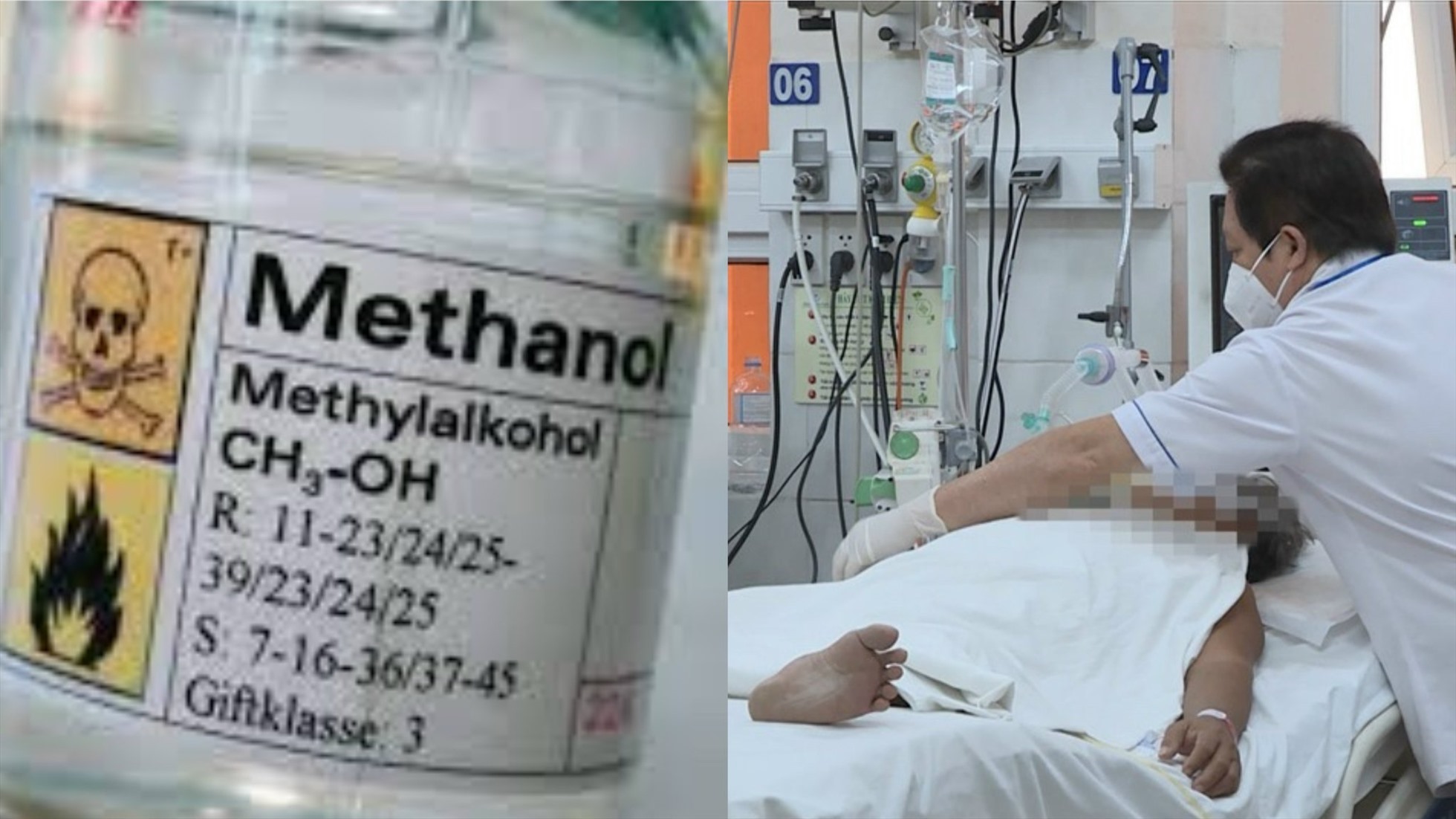 Nhiều bệnh nhân nhập viện do hoại tử vô khuẩn chỏm xương đùi do rượu. Đồ hoạ: Hạ Mây