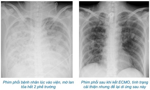 Hình ảnh chụp phổi người bệnh. Ảnh: Bệnh viện cung cấp