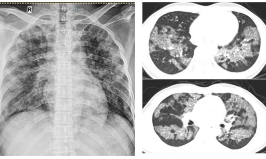 Hình ảnh tổn thương lan tỏa hai phổi của người bệnh trước khi rửa phổi. Ảnh: BVCC